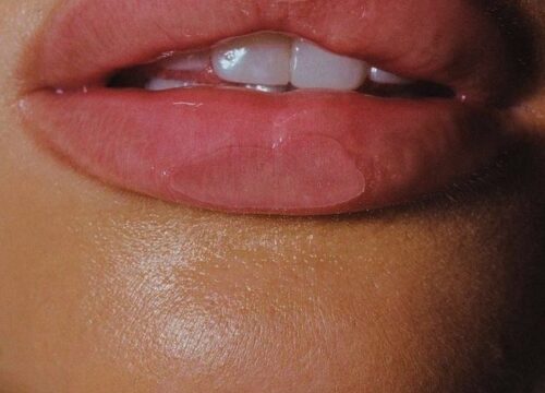 Dermal Fillers