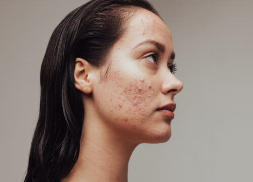 Photo of a woman with acne and acne scars on her face