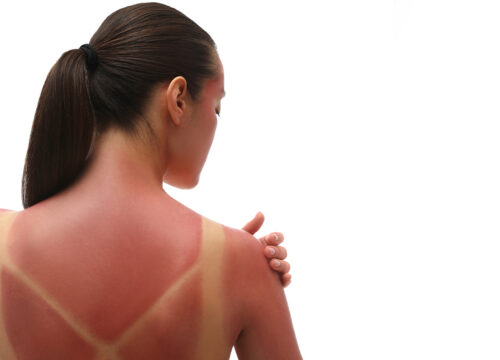Photo of a woman with a sunburn and sun damage on her back