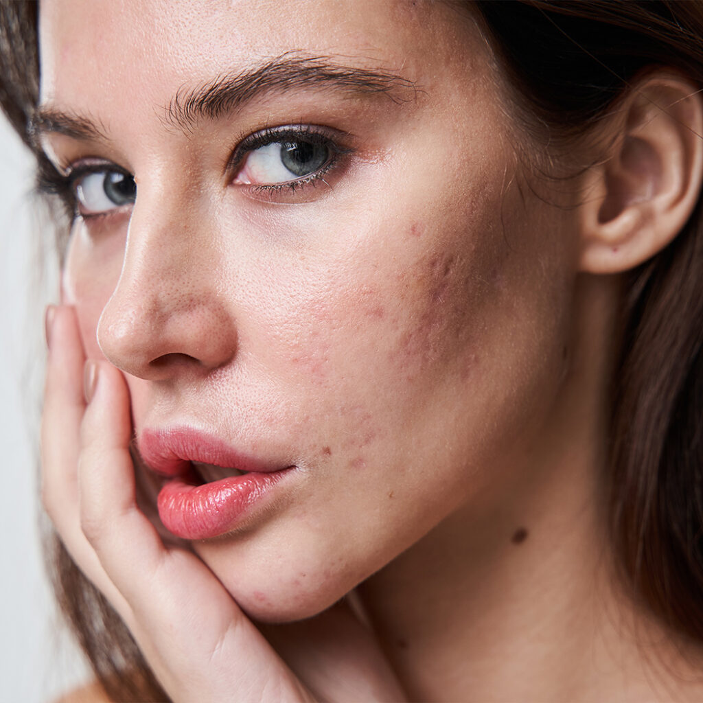 Photo of a woman with acne touching her face