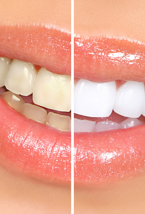 Photo of before and after teeth whitening results